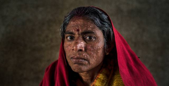 Una paciente de leishmaniasis en un hospital de MSF en Hajipur (India).