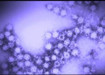 ¿Qué es el enterovirus y cuáles son sus síntomas?