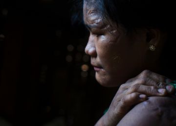 Than Than Ei muestra sus cicratices en la cara y parte superior del cuerpo.