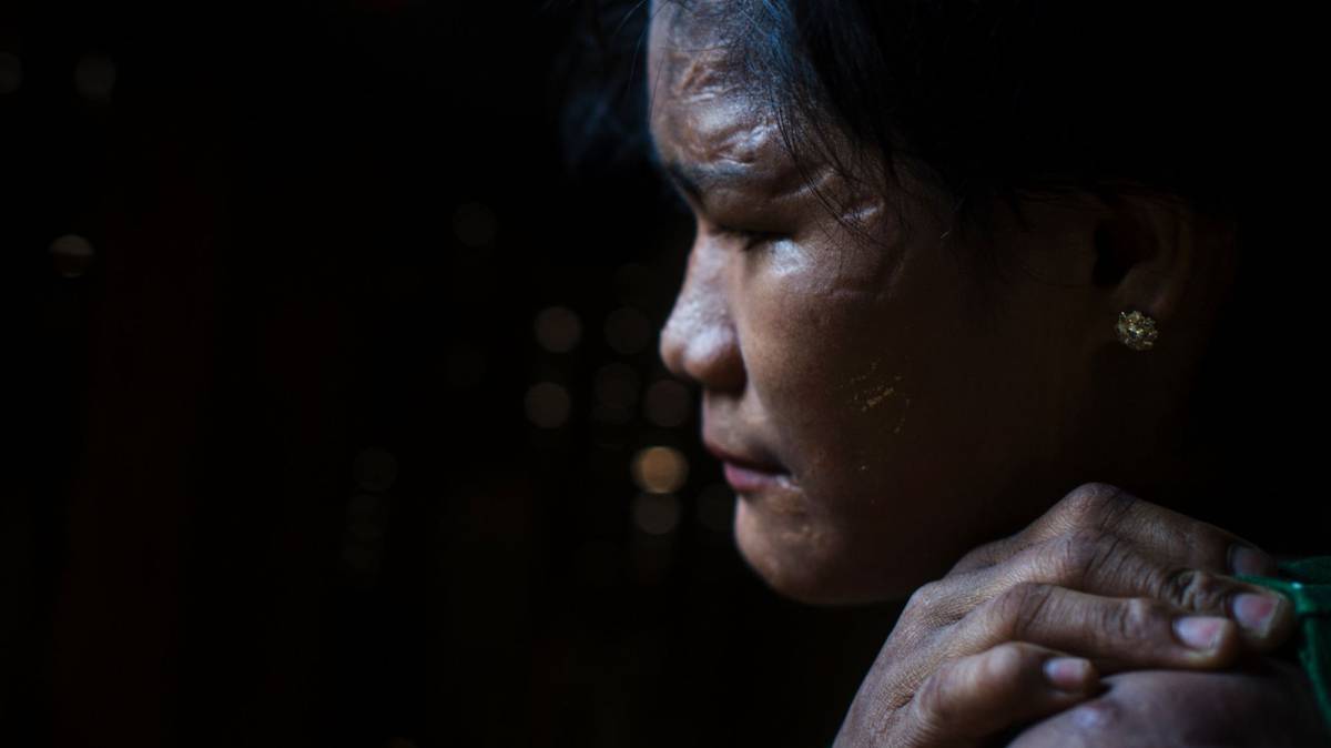 Than Than Ei muestra sus cicratices en la cara y parte superior del cuerpo.