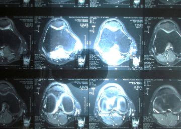 Resonancia magn&eacute;tica de una rodilla.