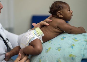 Una terapeuta trata a un beb&eacute; con microcefalia debido al virus del zika el pasado 22 de enero en Salvador, Brasil. 
