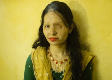 Reshma Qureshi, atacada con ácido a los 17 años.