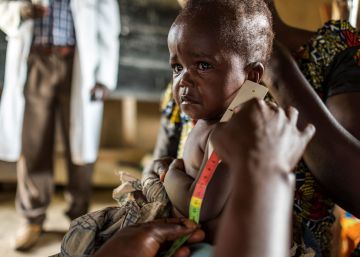 Un enfemero mide el per&iacute;metro braquial de un ni&ntilde;o para saber si padece desnutrici&oacute;n en Mbau, RDC. 