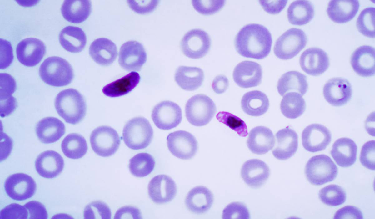 Muestra de sangre que contiene varias formas del par&aacute;sito de la malaria, 'Plasmodium falciparum'