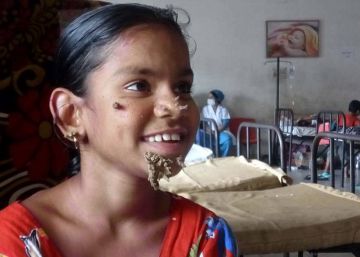 Bangladesh identifica a la primera ‘mujer árbol’