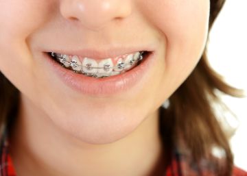 Brackets, la reinvención de la ortodoncia