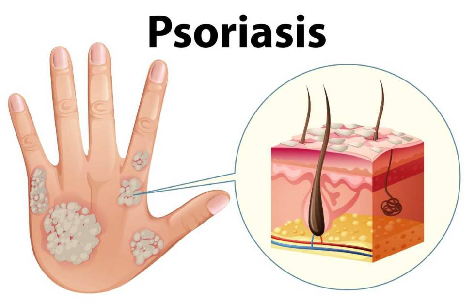 Enfrentarse a la psoriasis con tan solo siete años