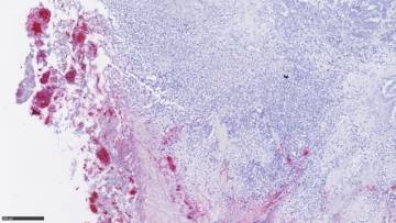 Un tumor colorrectal infiltrado por 'Fusobacterium' (en rojo).
