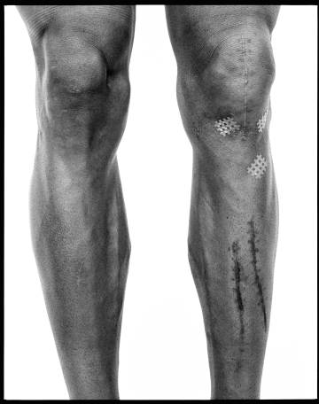 Las piernas de Valverde con las cicatrices de la caída que sufrió en el Tour de 2017.