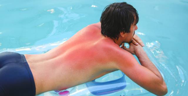 Sunburn can have an adverse effect on health.