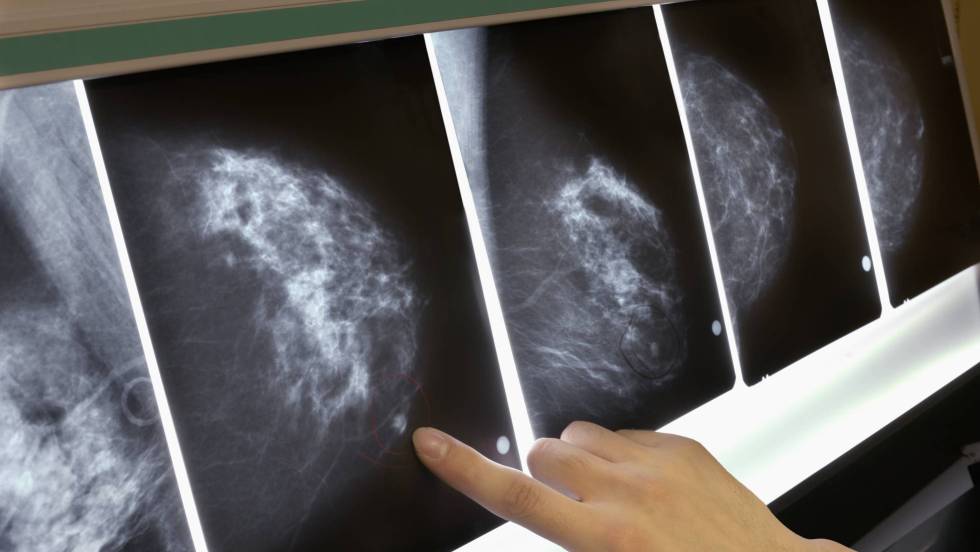 Un autotrasplante elimina el cáncer en una paciente con metástasis