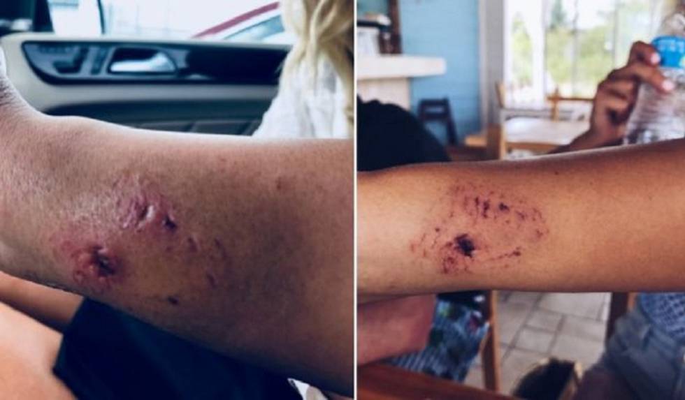 La herida de Katarina Zarutskie en el brazo tras la mordedura de un tiburón.