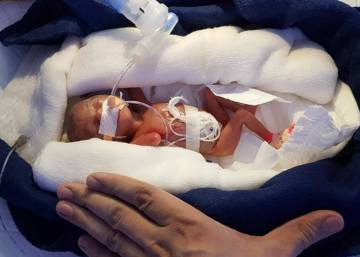 sobrevive un bebe de 34 semanas de diabetes gestacional
