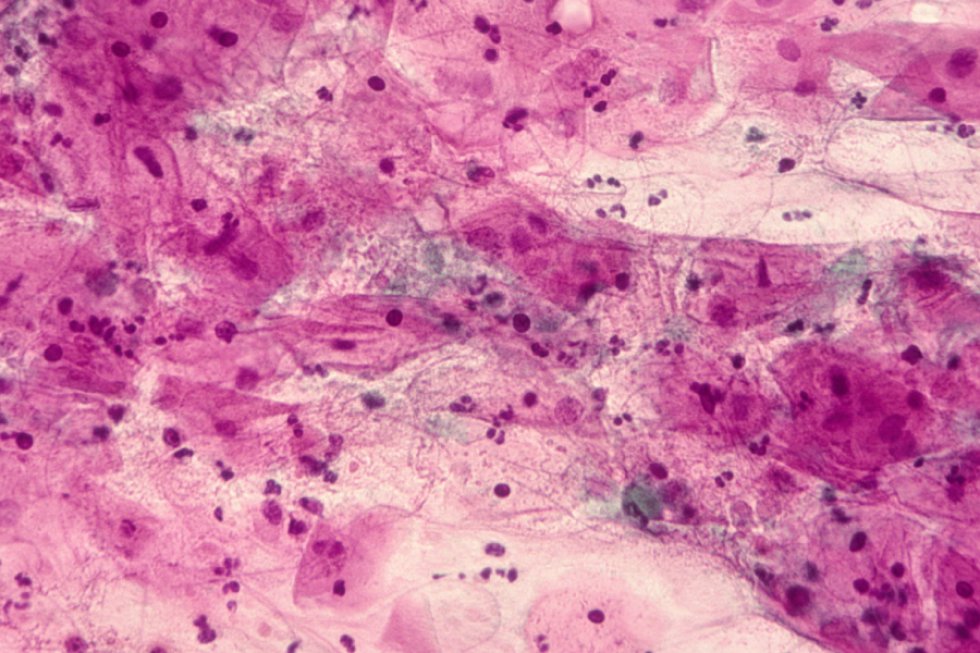 uretritis hombre cuanto dura