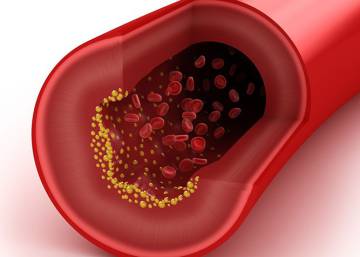 Cómo bajar el colesterol cuando las estatinas ya no funcionan