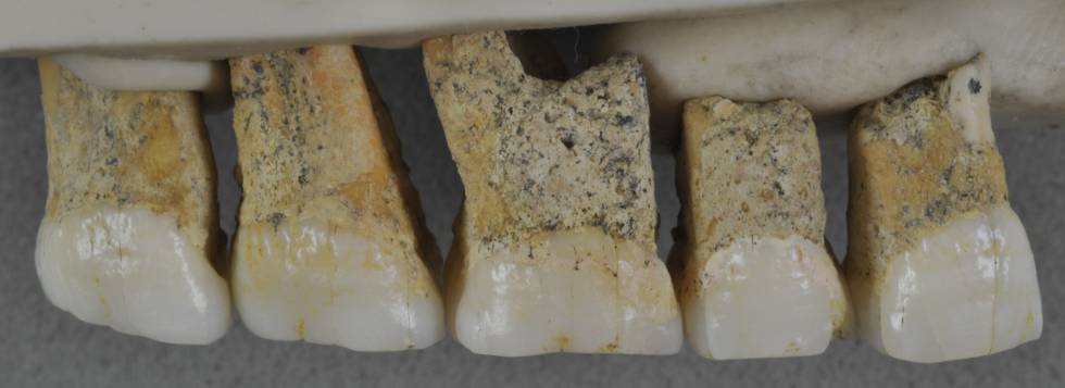 Dientes superiores del CCH6 individual, el espécimen tipo de la nueva especie Homo luzonensis. 