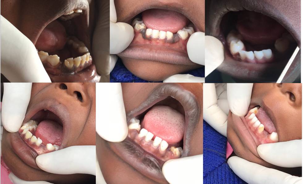 Ejemplo de las consecuencias de la mutilación dental.