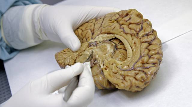 Disección de un cerebro.