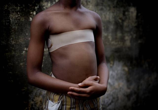 Una mujer, que sufrió el planchado de senos, en Camerún.