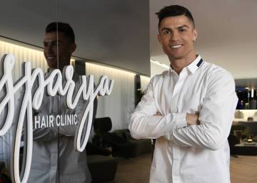 La industria de los microinjertos capilares despega en España