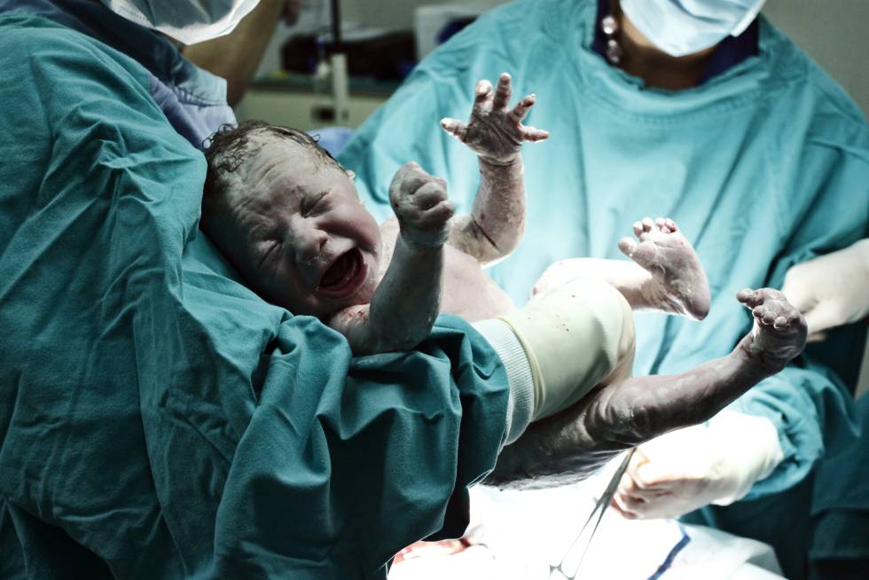 caracteristicas de los bebes nacidos por cesarea