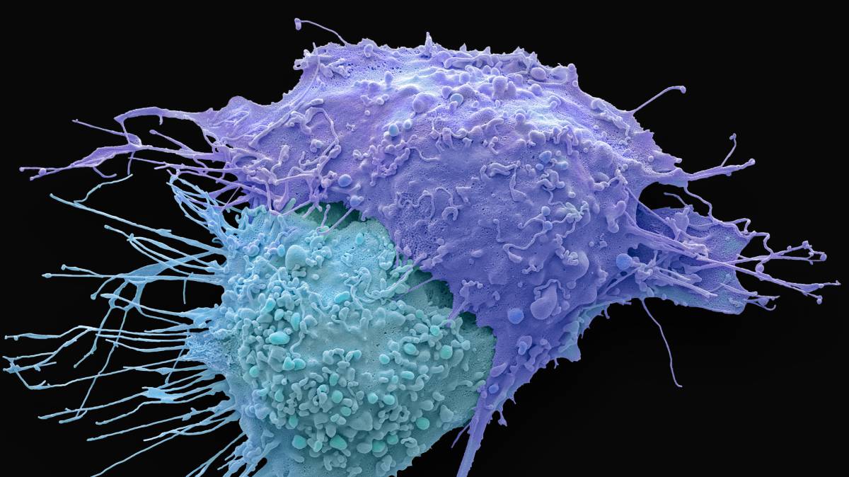 Células de cáncer de ovario.