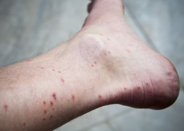 Picaduras de mosquito en el tobillo de un hombre.