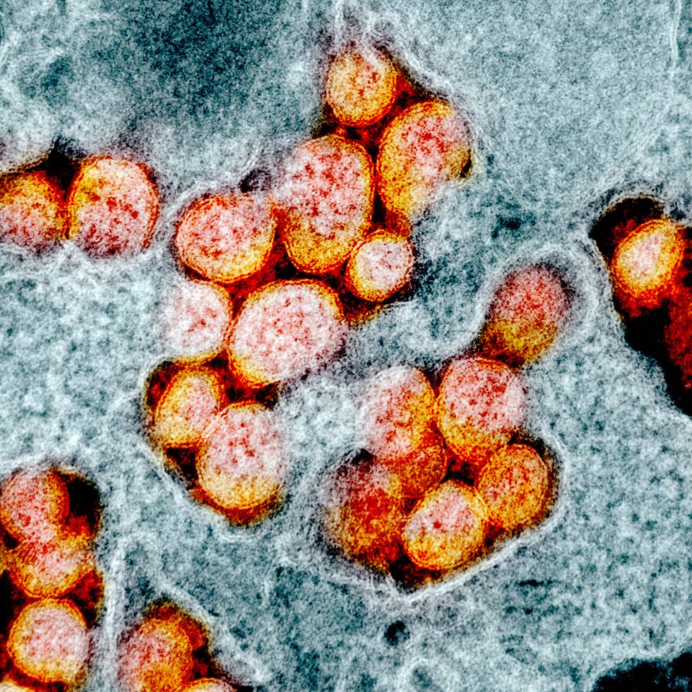Partículas de vírus SARS-CoV-2 isoladas na amostra de um paciente.