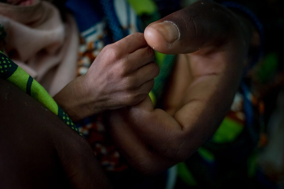 Hadida, de cinco meses y con malnutrición aguda severa