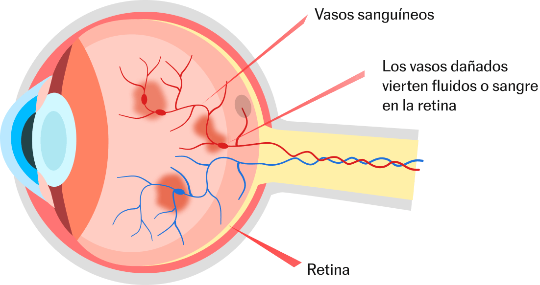 EDEMA MACULAR