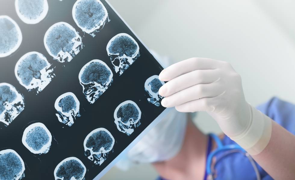 Un médico estudia el daño cerebral en un paciente.