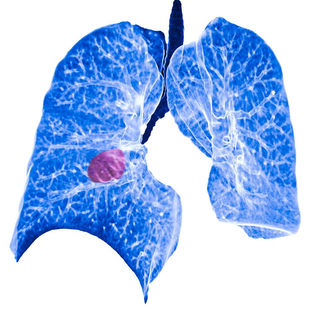 Tumor en pulmón