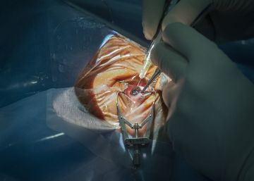 La espera para borrar las cataratas va por comunidades