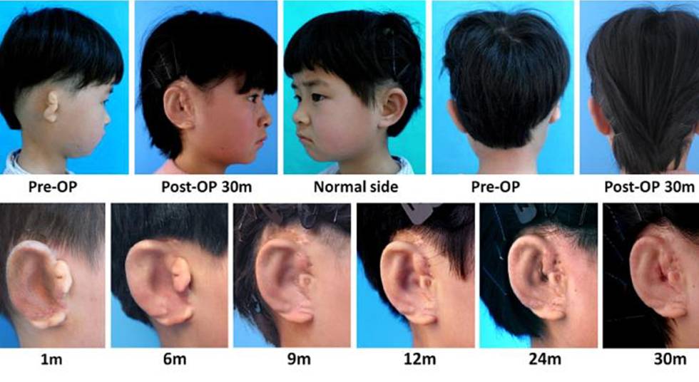 Imágenes de uno de los pacientes tratado con la nueva técnica para implantar una nueva oreja. 